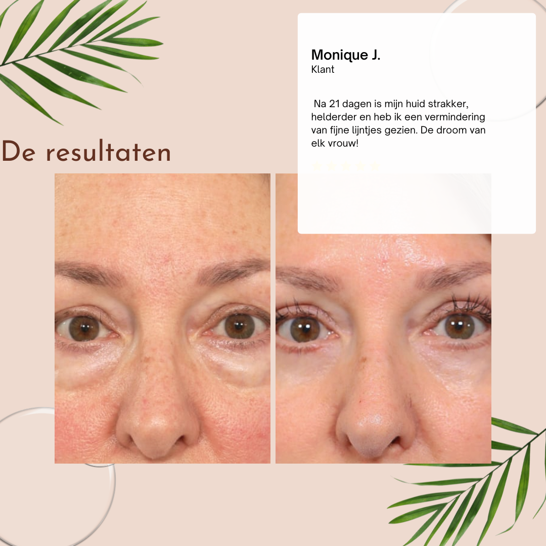 CËLYN™ Ooglifter crème - 1+2 GRATIS